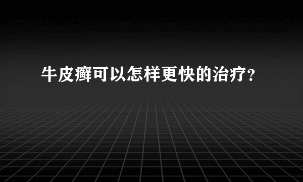 牛皮癣可以怎样更快的治疗？