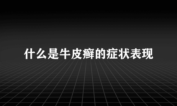 什么是牛皮癣的症状表现