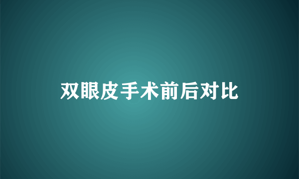 双眼皮手术前后对比